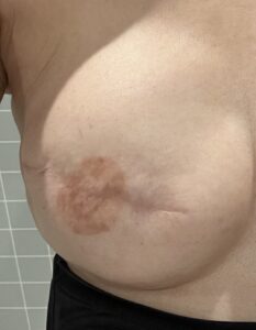乳房再建画像